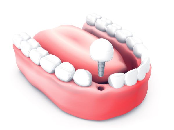 dental implants cobham surrey